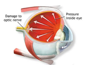 Optic Nerve Damage Causes Pressure
